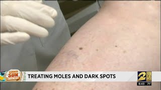 Treating Moles and Dark Spots