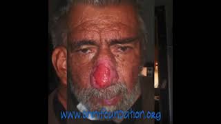 Roger’s Nose Transformation: As seen on Dr. Pimple Popper’s Season 6, Episode 2