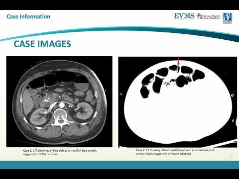 Thumbnail image of video presentation for Diabetic Ketoacidosis and Acute Mesenteric Ischemia in Adults: An Underreported Association