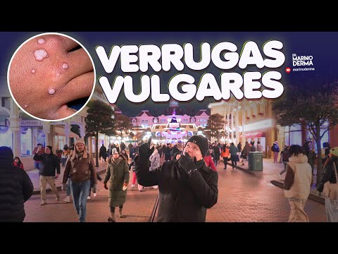 VERRUGAS VULGARES