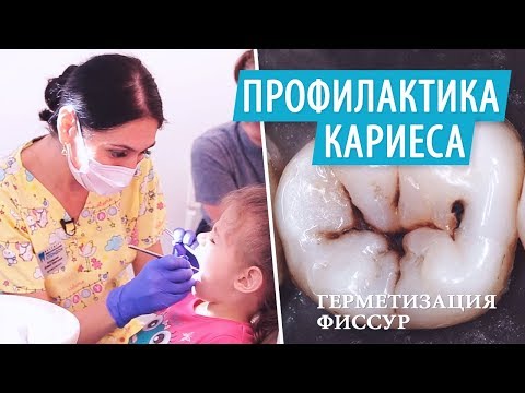 Герметизация фиссур у детей. Профилактика кариеса
