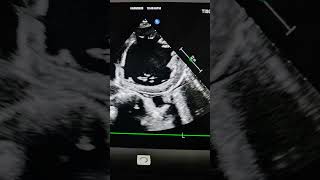 Download lagu Severe AR #aortic_valve_insufficiency #2decho #cardiacrehab #ar #cardiology #biology mp3 Download lagu Severe AR #aortic_valve_insufficiency #2decho #cardiacrehab #ar #cardiology #biology mp3