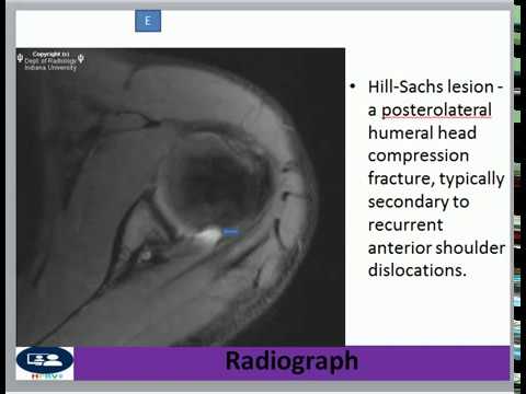 Humeral avulsion