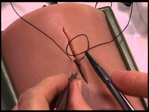 Running Subcuticular