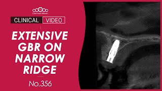 Download lagu Implant placement on narrow ridge with extensive GBR [Dr. Jeon Inseong] mp3