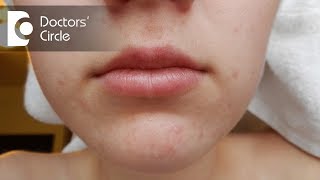 What causes acne around the mouth? - Dr. Aruna Prasad