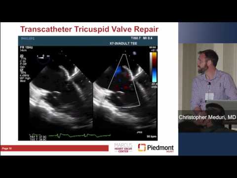 Transcatheter Treatment of Tricuspid Valve Disease: Treating the Forgotten Valve