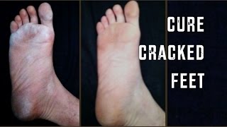 How to Cure Dry, Cracked Feet | Cheap Tip #165