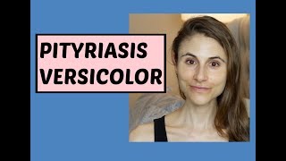 Pityriasis (Tinea) versicolor: Q&A with dermatologist Dr Dray