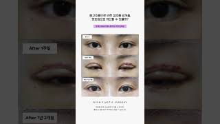 스마일 메이크오버 성형 시술