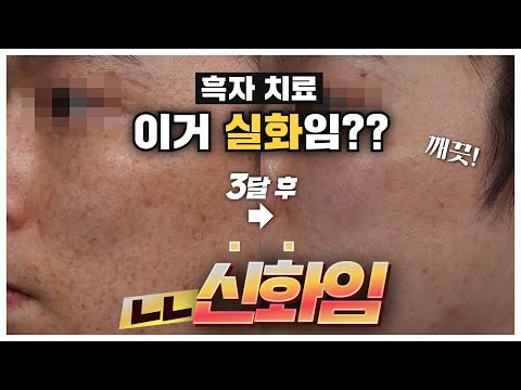 흑자 잡티 치료하면 꿀피부는 덤으로? 표피층 깊이 있는 흑자는 어떻게 치료할까? (※주근깨 아님주의!)