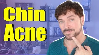 How to CLEAR Chin Acne Fast! | Routine and Treatment | Chris Gibson