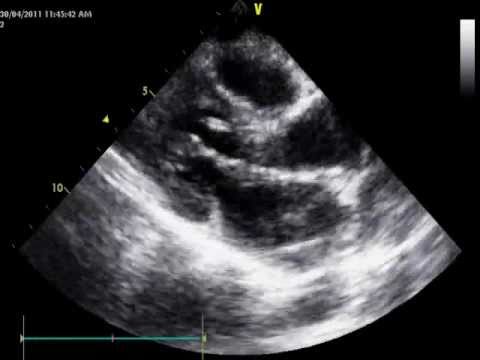 Double Fibromuscular Band In The Left Ventricle And Bicuspid Aortic Valve With Raphe