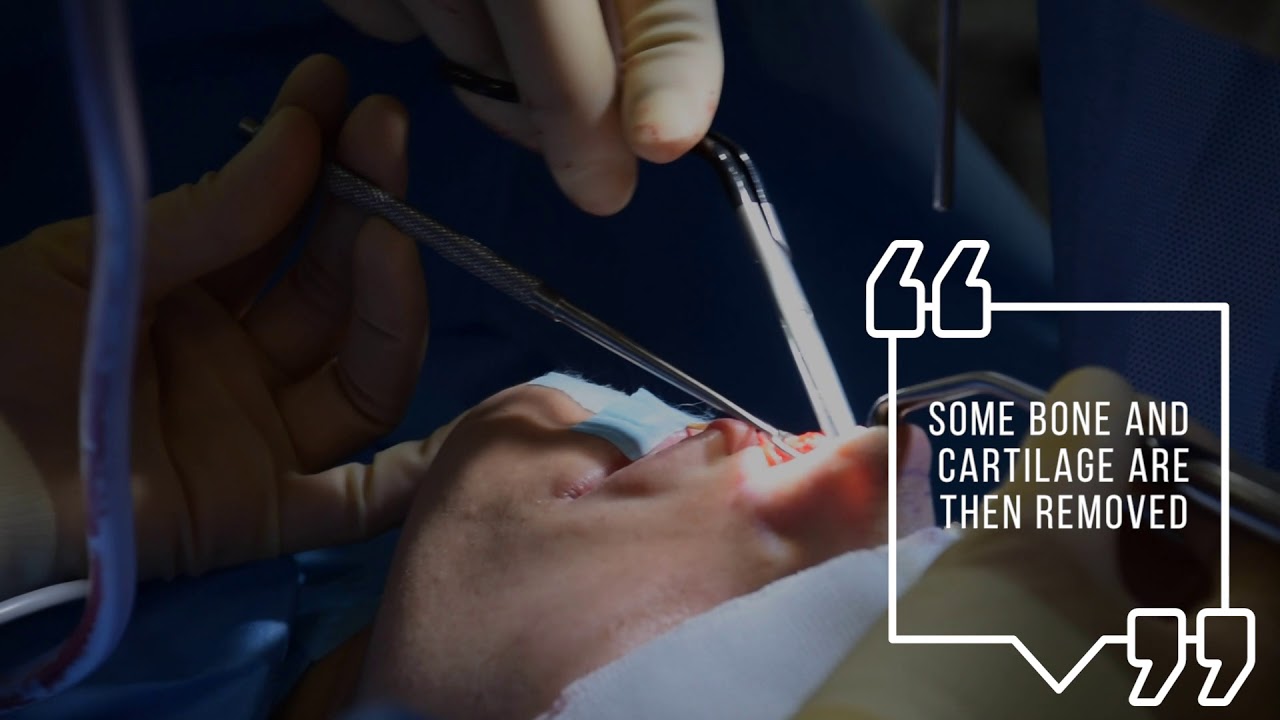 Reducing a Nasal Hump