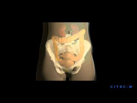 La vejiga hiperactiva