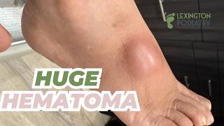 EXPLOSIVE Hematoma