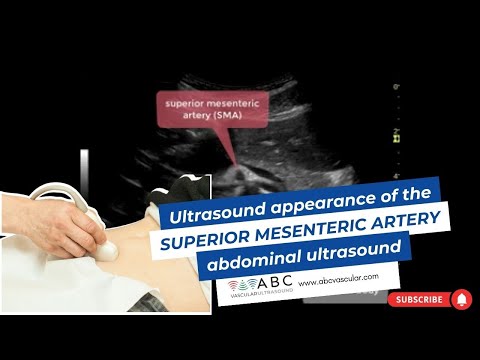 ULTRASOUND APPEARANCE OF THE SUPERIOR MESENTERIC ARTERY: ABDOMINAL ULTRASOUND