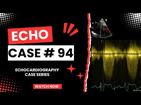 ECHO CASE 94 | Echocardiography for Beginners | Echocardiogram Interpretation | 2D Echo Basics