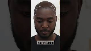 Afro Hair Transplant Turkey - HOI Method #hairtransplant #hairofistanb