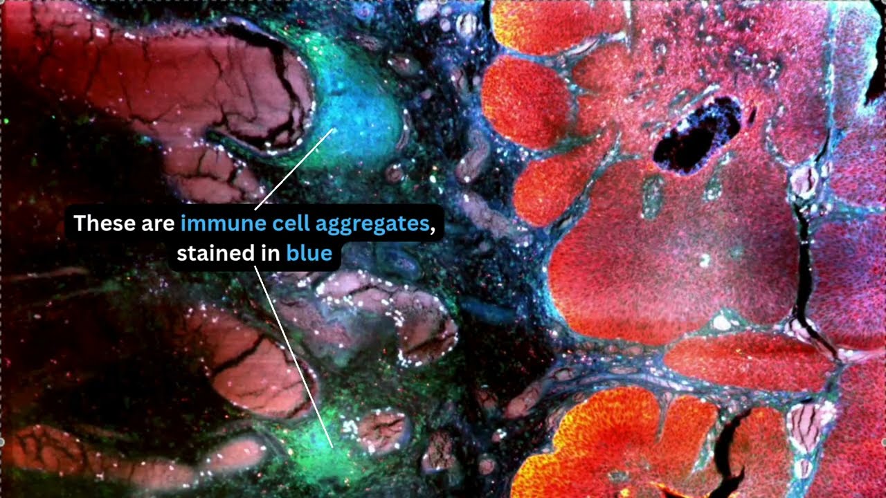 3D Bladder Cancer Showcase