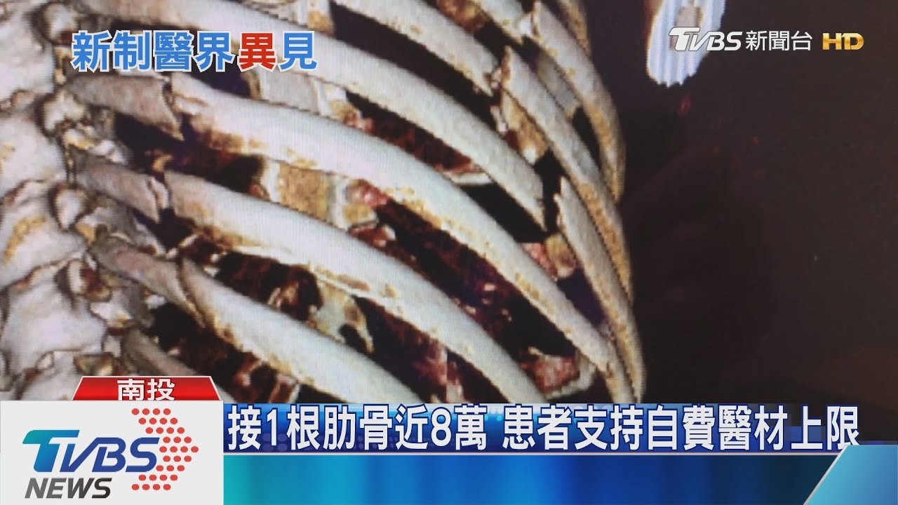 接1根肋骨近8萬 患者支持自費醫材上限