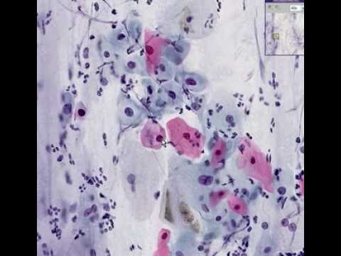 Histopathology Cervix --Low grade squamous intraepithelial l