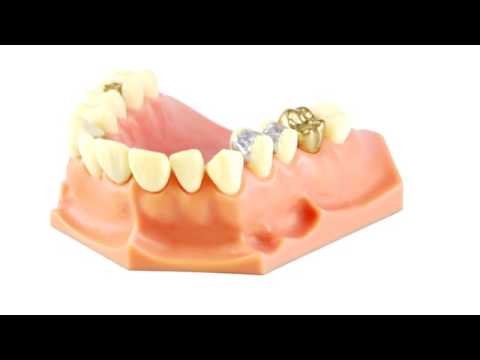 Amalgam entfernen lassen?