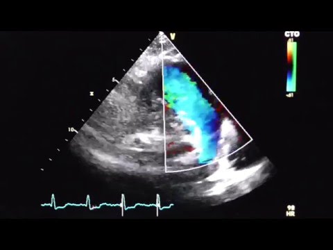 Hypertonie bei Schwangeren Physiomer hypertensive Gegen