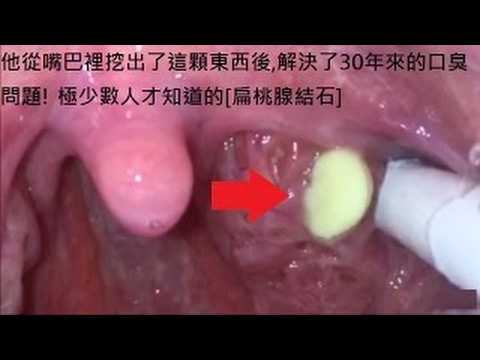 閒聊 扁桃腺結石 噁心 有圖慎入 Ott板 Disp s 閒聊 扁桃腺結石 噁心 有圖慎入 Ott板 Disp s