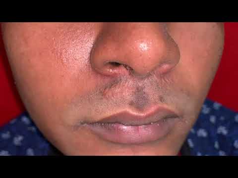 Moustache Transplants To Hide Upper Lip Scar