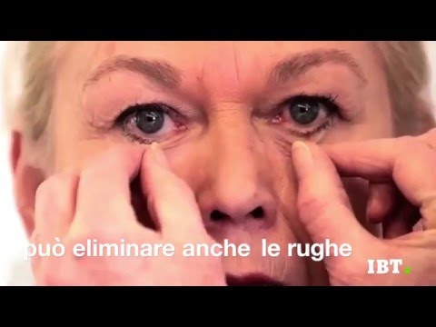 Costo di macinatura laser di posti di pigmentary La differenza di lentiggini da pigmentary nota su