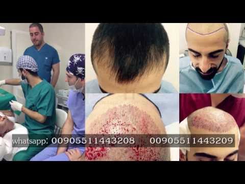 زراعة الشعر في تركيا - مقتطفات من تجارب العملاء مع يني هير