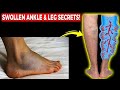 Edema: Swollen Feet, Swollen Ankles & Swollen Legs [FIX Them FAST!]
