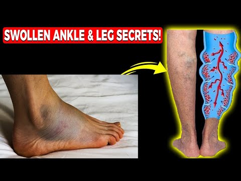 Heel Spurs Plantar Fasciitis BEST Home Treatment 2022