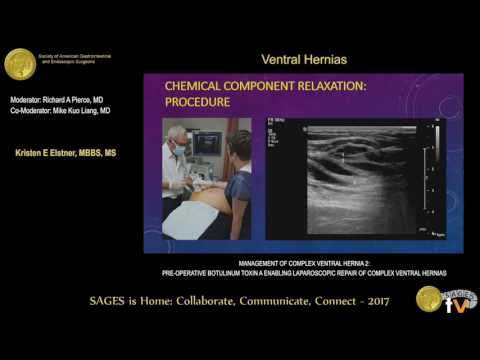 Management of complex ventral hernia repair: Preoperative botulinum toxin A