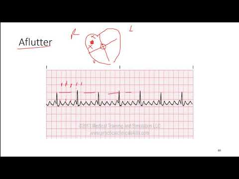 ECG 7: Atrial Flutter and Atrial Fibrillation
