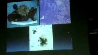 4_Dr. Faisal  Amyloid Mucin part 2