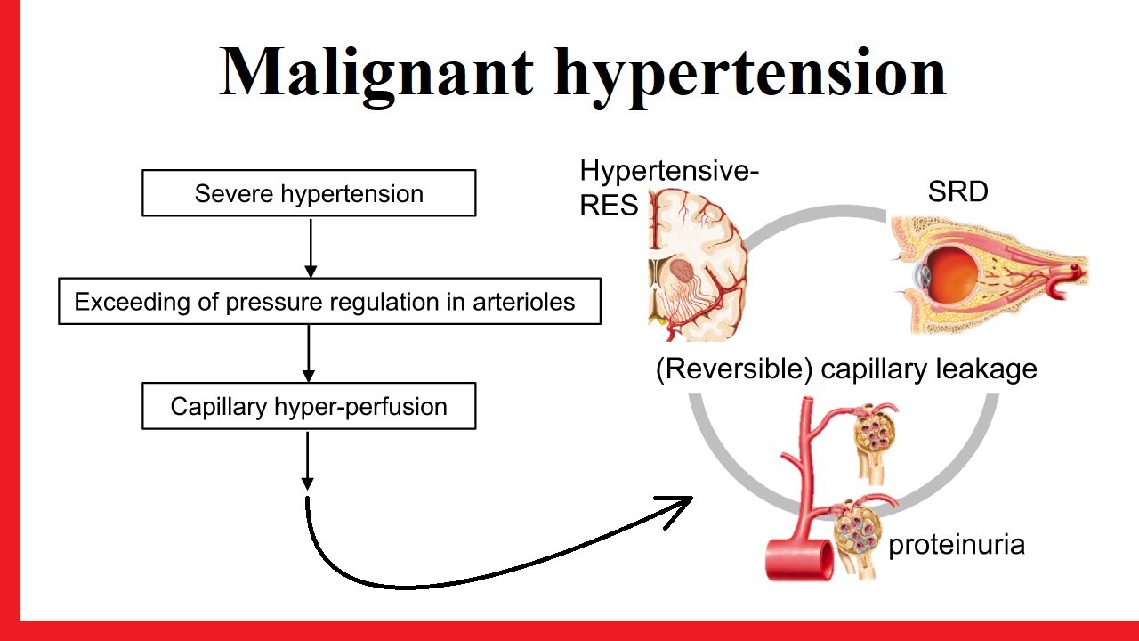 malignant hypertension