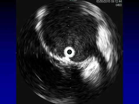 Endovascular Stent Grafting For Leaking Ascending Aortic Pseudoaneurysms