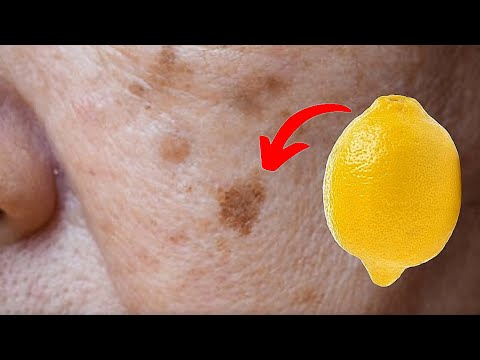 How to remove age spots with lemons🤯💥