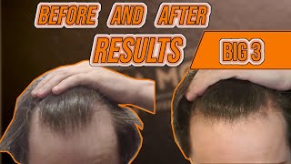 Minoxidil Hair Regrowth Results: The Big 3 on Reddit
