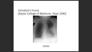 Pulmonary Embolism:Chronic Thromboembolic Diseased