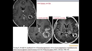 65. Pseudoprogression and pseudoresponse; post treatment glioma MRI, RANO, Stupp, Bevacizumab, rCBV