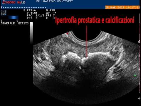 rimedio domestico per prostata bph rimedio domestico per prostata bph