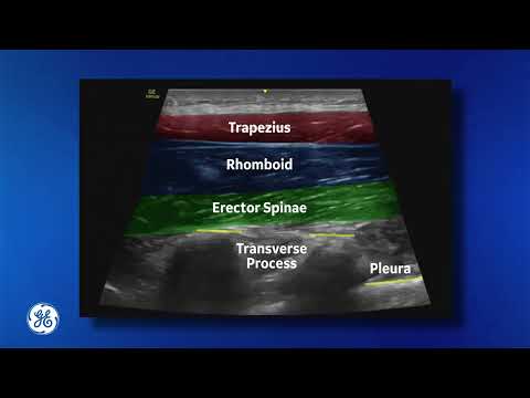 Venue Family | Erector Spinae Plane Block