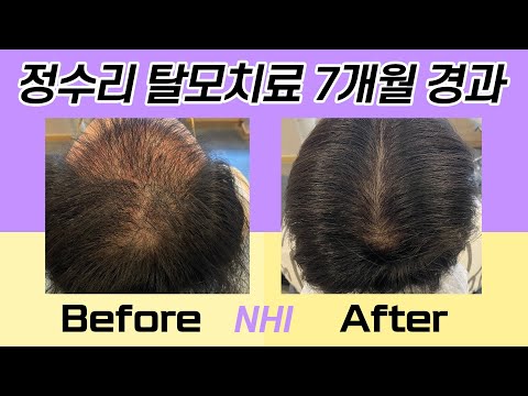 정수리탈모치료 정수리모발개선 210일 경과 I 뉴헤어 I 모발이식 I 탈모치료 I Before&After