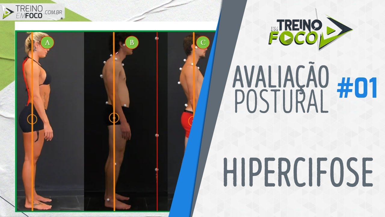 Desvio Postural da Coluna - Hipercifose - Avaliação Postural #01