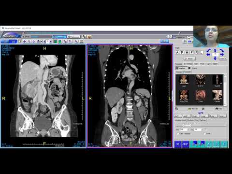 Fast growing right renal mass w/ renal vein invasion (Dx Metastatic anal SCC | Victoria Chernyak)