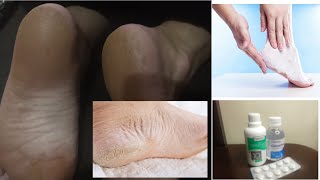 Ps Rachados / Creme Caseiro Para os Ps/ FAA CREME COM 3 INGREDIENTES PARA RACHADURA NOS PS!!!