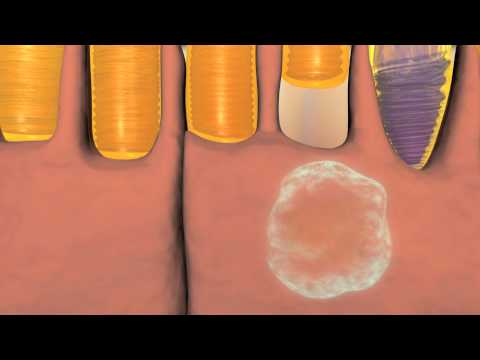 Animation of Wet and Dry Macular Degeneration